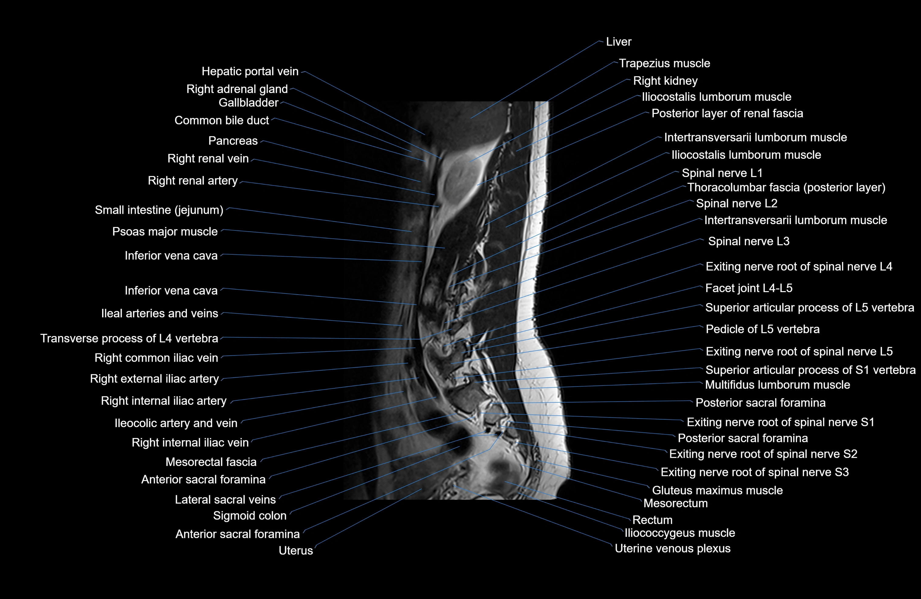 MRI lumbar spine sagittal cross sectional anatomy 3T radiology  image-img-00001-00004.webp